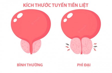 PHÌ ĐẠI TUYẾN TIỀN LIỆT LÀ BỆNH GÌ?