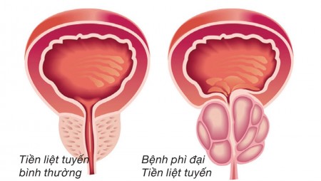 GIẢI ĐÁP THẮC MẮC VỀ CÁCH ĐIỀU TRỊ PHÌ ĐẠI TUYẾN TIỀN LIỆT