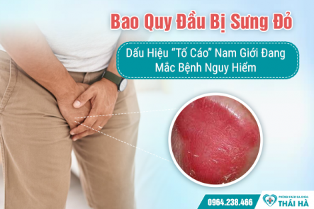 Bao Quy Đầu Bị Sưng Đỏ: Dấu Hiệu “Tố Cáo” Nam Giới Đang Mắc Bệnh Nguy Hiểm