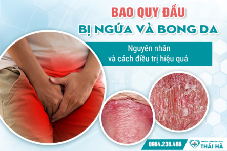Bao quy đầu bị ngứa và bong da: Nguyên nhân và cách điều trị hiệu quả 