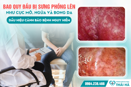 Bao quy đầu bị sưng phồng lên như cục mỡ, ngứa và bong da – Dấu hiệu cảnh báo bệnh nguy hiểm
