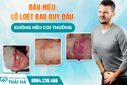 Dấu Hiệu Lở Loét Bao Quy Đầu Không Nên Coi Thường