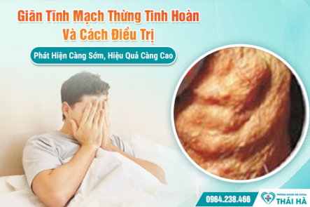 Giãn Tĩnh Mạch Thừng Tinh Hoàn Và Cách Điều Trị: Phát Hiện Càng Sớm, Hiệu Quả Càng Cao