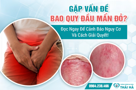 Gặp Vấn Đề Bao Quy Đầu Mẩn Đỏ? Đọc Ngay Để Cảnh Báo Nguy Cơ Và Cách Giải Quyết!