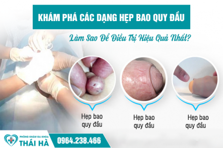 Khám Phá Các Dạng Hẹp Bao Quy Đầu: Làm Sao Để Điều Trị Hiệu Quả Nhất?