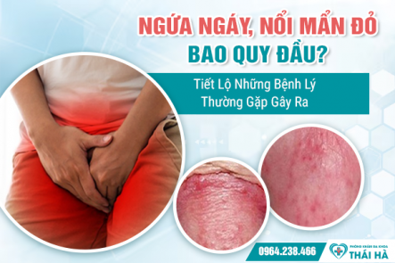 Ngứa Ngáy, Nổi Mẩn Đỏ Bao Quy Đầu? Tiết Lộ Những Bệnh Lý Thường Gặp Gây Ra