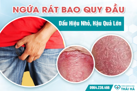 Ngứa Rát Bao Quy Đầu: Dấu Hiệu Nhỏ, Hậu Quả Lớn