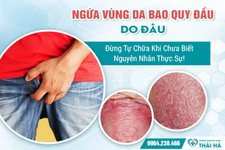 Ngứa Vùng Da Bao Quy Đầu Do Đâu? Đừng Tự Chữa Khi Chưa Biết Nguyên Nhân Thực Sự!