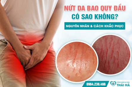 Nứt Da Bao Quy Đầu Có Sao Không? Nguyên Nhân & Cách Khắc Phục