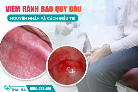Viêm Rãnh Bao Quy Đầu - Nguyên nhân và Cách điều trị