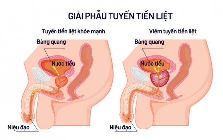 TRIỆU CHỨNG BỆNH VIÊM TUYẾN TIỀN LIỆT 