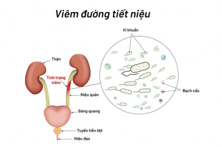 Cách chữa viêm đường tiết niệu hiệu quả- an toàn 
