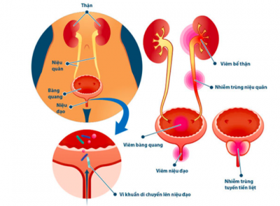 Viêm đường tiết niệu- Nỗi ám ảnh của nam giới 