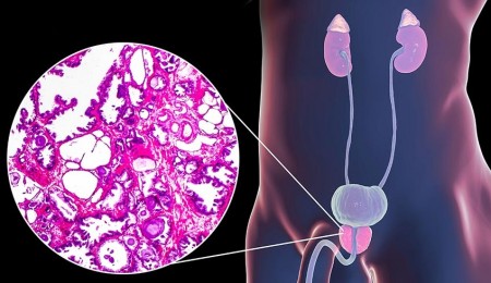 TRIỆU CHỨNG PHÌ ĐẠI TUYẾN TIỀN LIỆT