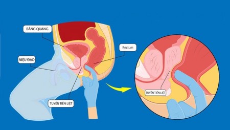 NGUYÊN NHÂN PHÌ ĐẠI TUYẾN TIỀN LIỆT