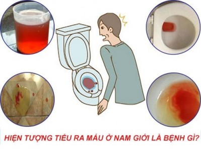 Đi tiểu buốt và ra máu! Hãy cẩn thận