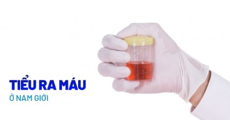 Đi tiểu ra máu là dấu hiệu của bệnh gì? Tìm hiểu về hiện tượng đi tiểu ra máu