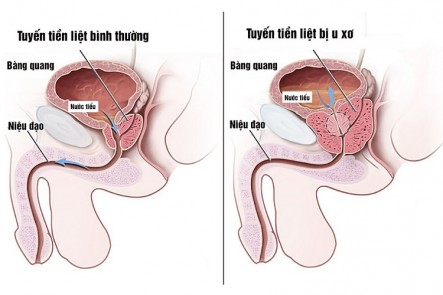  U PHÌ ĐẠI TUYẾN TIỀN LIỆT LÀ GÌ?