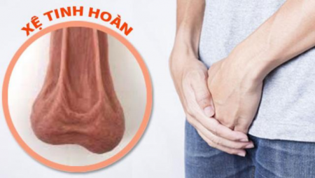 Hiện tượng xệ tinh hoàn ở nam giới và những điều cần lưu ý 