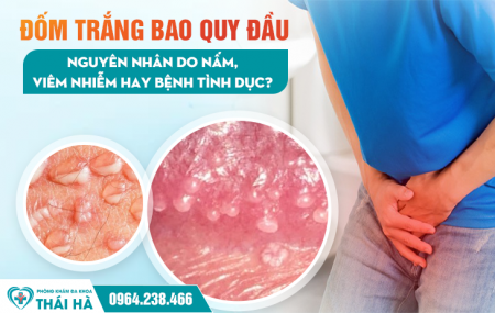 Đốm Trắng Bao Quy Đầu: Nguyên Nhân Do Nấm, Viêm Nhiễm Hay Bệnh Tình Dục?