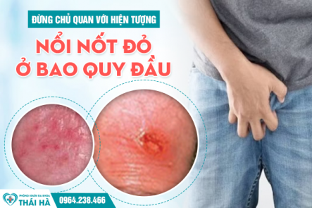 Đừng Chủ Quan Với Hiện Tượng Nổi Nốt Đỏ Ở Bao Quy Đầu