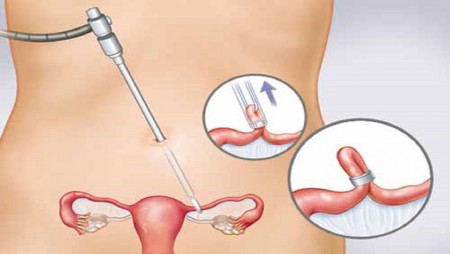 TÌM HIỂU MỔ THÔNG TẮC VÒI TRỨNG